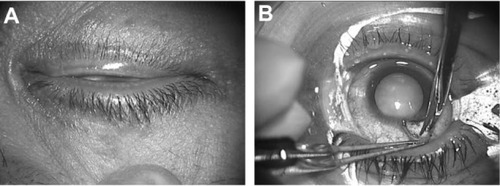 Figure 6 The eye of a 38-year-old man with atopic dermatitis. (A) The eyelid margins before preoperative disinfection. The skin was dry, and a large amount of secretion from the meibomian glands was seen. (B) The eyelashes and the eyelids were completely draped.