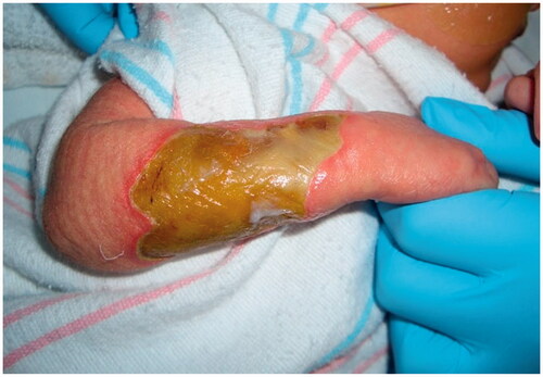 Figure 1. The initial full thickness dorsoulnar lesion of the right forearm.
