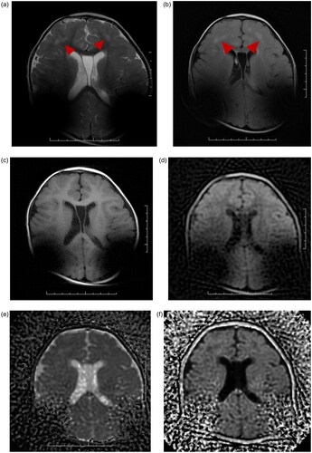 Figure 3. A: Bilateral deep frontal lobe long T2 signal. B: Propeller T2 Flair sequence. C: Propeller T1 sequence. D: Propeller DWI sequence. E: Propeller DWI sequence-ADC map. F: Propeller DWI sequence-eADC map.