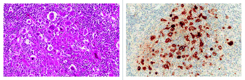 Figure 1. Classical Hodgkin lymphoma of the nodular sclerosis type. (A) Hematoxylin and eosin (H&E) staining. (B) The Reed-Sternberg cells positively stained for CD30.