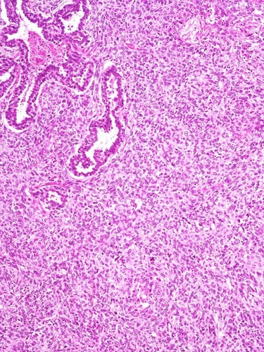 Figure 10 Pulmonary blastoma showing a minor component of well-differentiated adenocarcinoma (top) admixed with an undifferentiated blastematous component.