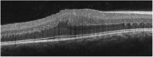 Figure 1. Patient 1 at 6 years of age. There is significant disruption of the inner retina with marked thickening and loss of normal foveal contour. Central subfield thickness (ILM-RPE) is 529 microns.