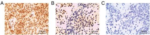 Figure 2 O6-methylguanine-DNA methyltransferase (MGMT) immunohistochemistry of the patient. (A) strong positivity (++); (B) positivity (+); (C) negativity (–).