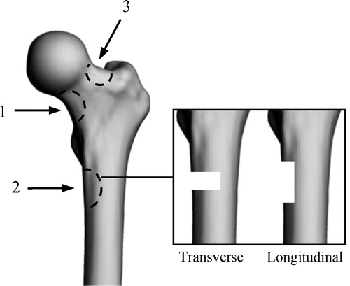 Figure 1. Defects location and orientation (Adapted from Tanck et al., Citation2009). Location: 1, lower part of the femoral neck; 2, under the lesser trochanter; 3, upper part of the femoral neck. Orientation: transverse; longitudinal.