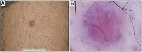 Figure 2 Primary cutaneous marginal zone lymphoma: clinical findings. (A) Male, 18 years old. Small erythematous papule on the volar surface of the left thigh. (B) Dermoscopically, the lesion appeared as a salmon‐coloured area with prominent blood vessels with serpentine (linear‐irregular) morphology.