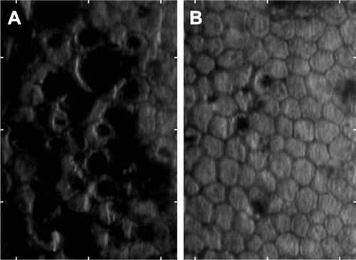 Figure 2 Specular microscopy reveals marked endothelial cell loss. Concurrent with the asymmetry of corneal edema at presentation, the right eye (A) demonstrates worse polymegethism than the left (B). Dark opacities, which may represent toxic byproducts, debris or pigment, provide a guttate-like appearance with slit-lamp biomicroscopy. The area is 0.1 mm2.