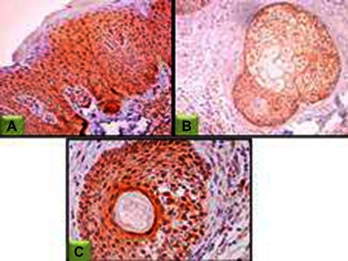 Figure 6 STAT3 expression in lesional skin sections.Abbreviation: STAT3, signal transducer and activator of transcription.