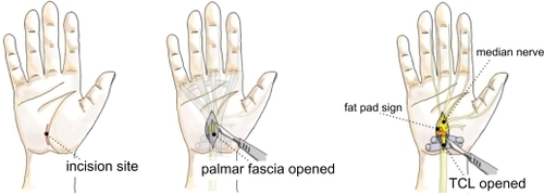 Figure 4 Mini-open carpal tunnel release.