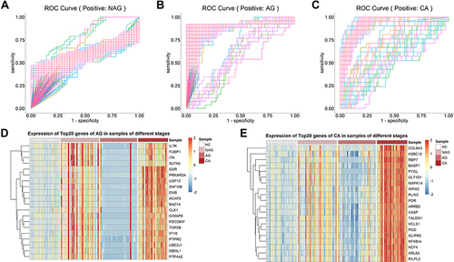 Figure 4 Screening of genes with diagnostic potential. (A–C) The discriminative ability of genes in NAG, AG and CA for corresponding stage samples was analyzed by ROC curve. (D and E) The expression of the top 20 genes ranked by AUC value in AG and CA.