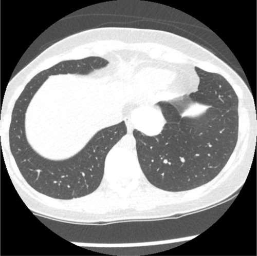 Figure 7 CT thorax.