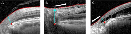 Figure 2 The classification of PRS. Red point and blue arrow represent BMO in three pictures. (A) Normal case: No PRS is present. (B) Behind group: The proximal edge of the PRS does not exceed the BMO and heads for the macular (white arrow). (C) Ahead group: PRS extends toward the optic disc beyond the BMO (white arrow).