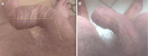 Figure 1 Demonstrating how we measured the penile curvature. Picture (A) is taken at inclusion, and picture (B) displays curvature at six months follow-up. Background: A 72-year old male who has suffered from PD for 12 months. He has previously been diagnosed with dupuytren’s contracture. He has received ESWT for five consecutive weeks while applying the vacuum pump at home. His penile curvature improved 35 degrees. He reported moderate/high self-rated effect.