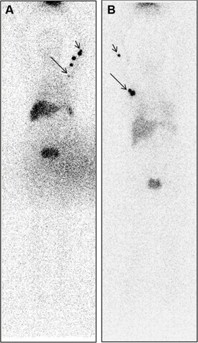 Figure 4 Lymphoscintigraphy. Different distributions of lymph nodes in the ALND and SLNB groups.