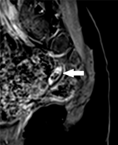 Figure 5 Sagittal post-gadolinium contrast T1-weighted fat suppressed image shows nonenhancing calcified oval lesion (arrow) in the left adnexa.