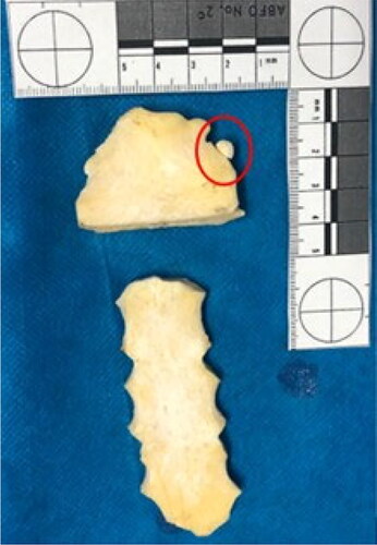 Figure 5. Sternum showing complete section with loss of the lower third of the manubrium. A rare anatomical variation was also seen at this site, a so-called suprasternal or episternal bone (see the red circle).