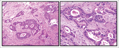 Figure 1. Histopathology of rectal adenocarcinoma. Legend: Hematoxylin and eosin stained sections of the patient's primary rectal tumor (left) and hepatic metastases (right).