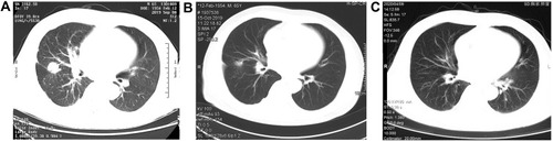 Figure 2 Medical imaging. CT scan with a right middle lobe lung mass before (A) and after (B) 1 month and 7 month (C) of afatinib treatment.