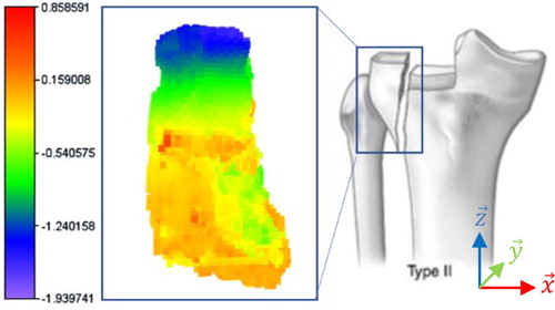 Figure 2. Displacement field in medio-lateral direction (x→) in the antero-posterior view (⊥ y→) of the separated fragment between the first and the second 3D images in mm.