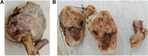 Figure 3 (A) Gross appearance of the appendix with a nodule over its tip. (B) Cut surface appearance of the appendix.