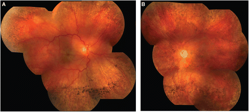 FIGURE 3  Composite fundus photographs of the right (A) and left (B) eyes 1 week after presentation, showing persistent “cherry red spot” and significant peripheral atrophy with sclerotic vessels and pigmentary changes in both eyes. There are also left optic atrophy and pigmentary changes in the left macula.