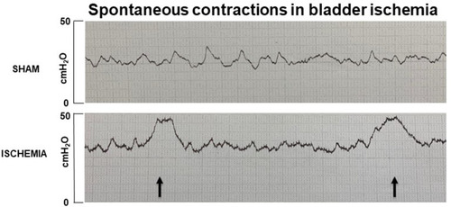 Figure 1 Cystometric recording of contractile activity in an animal with bladder ischemia is shown in comparison with sham control. Recurring spontaneous bladder contractions, characterized by intravesical pressure rises, were recorded in the ischemic bladder, suggesting detrusor overactivity. Minor fluctuation in bladder pressure without consequential contractions were recorded in the sham control animals. Intravesical pressure was recorded at a constant volume of 0.8 mL without bladder infusion. The recorder was calibrated at a sensitive scale of 0–50 cmH2O, so that all changes in intravesical pressure could be detected. Arrows point to recurring spontaneous contractions in the ischemic bladder.