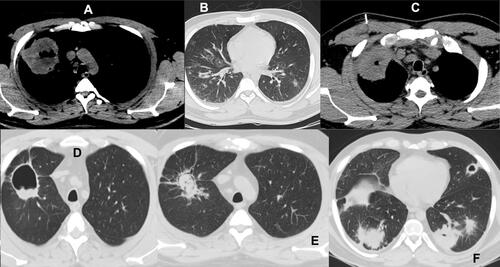 Figure 2 (A) CT thorax mediastinal window: right upper lobe mass like with central cavitation, 7.3×7 cm in size. (B) CT thorax pulmonary window, multiple bilateral nodules show dominance of lower lobe with bilateral mild bronchial wall thickening. (C) CT thorax mediastinal window: CT-guided needle biopsy from the right upper lobe mass with central cavitation. (D) CT thorax pulmonary window. Cavitation of the right upper lobe. (E) CT thorax pulmonary window, October 1/2021: Right upper lobe cavitary lesion measuring 3.8×2.4 cm, previously 3.8×3 x 2.8 cm with solid internal component and Crescent air sign, raising the possibility of underlying fungal ball. (F) CT thorax pulmonary window, October 1/2021: showed bilateral cavitary lung lesions, one right lower lobe, one lingua and 2 left lower lobe.