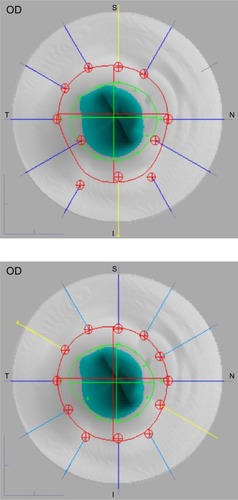 Figure 5 Optical coherence tomography optic nerve head images with automatic (top) and manual (bottom) delimitation.