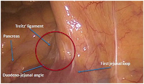 Figure 6. The suspensory muscle of duodenum, also known as the ligament of Treitz, is a thin muscular and fibrous strip of tissue connecting the junction between the duodenum, jejunum, and duodenojejunal flexure to connective tissue surrounding the superior mesenteric artery, the coeliac artery and to the right crus of the median diaphragmatic pillar (esophageal hiatus), although these attachments are quite variable.