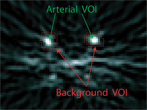 Figure 2. Labeling of the arterial and background VOIs using the bolus image.
