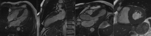 Figure 2. Cardiac MRI of a patient with ATTR CM (left to right) steady-state free precession cine; four chamber, two chamber, three chamber and short axis view demonstrating concentric LV hypertrophy