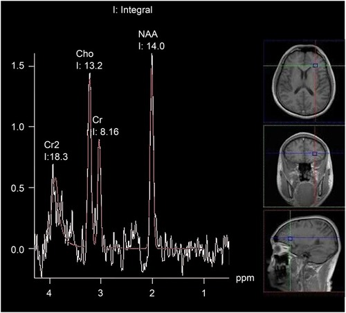 Figure 1 MR spectroscopic images of the post-stroke group. The MR spectroscopy image is shown on the left side. The right indicates the location of the left prefrontal lobe on MR images.