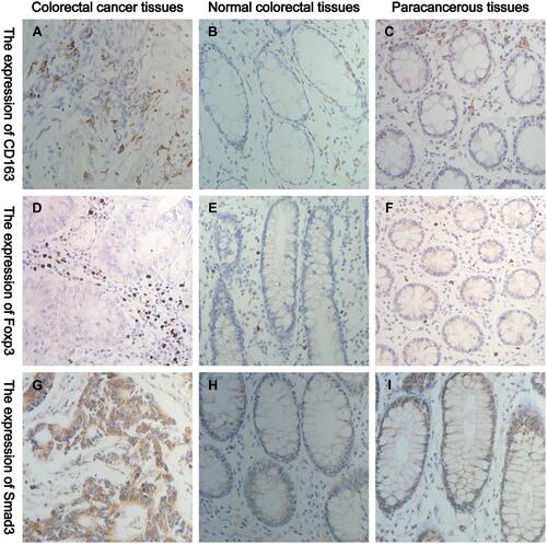 Figure 1 Representative IHC staining of CD163, Foxp3 and Smad3 in normal, paracancerous and CRC tissues (400× field). (A–C) The cell membrane and cytoplasm of M2-type macrophages are stained brown. (D–F) The nucleus of Tregs are stained brown. (G–I) The cell membrane and cytoplasm of Smad3+ cells are stained brown.