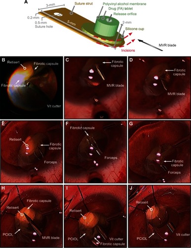 Figure 3 Surgical dissection in patient-A of fibrotic encapsulation of fluocinolone acetonide implant (Retisert™, Bausch & Lomb, Rochester, NY, USA). (A) Diagram detailing the dimensions of the fluocinolone acetonide implant. The dotted red lines indicate the placement and orientation of incisions created in the surrounding fibrotic capsule with a microvitreoretinal (MVR) blade. (B) The vitreous cutter was used to debulk any residual vitreous surrounding the fibrotic capsule. (C and D) The MVR blade was used to incise the fibrotic capsule, taking care to avoid contact with the delicate membrane of the implant. (E–G) Intraocular forceps were used to grasp the cut edge of the membrane and peel the membrane from the surface of the implant. (H) The MVR blade was used once more to ensure that all surrounding membranes were incised. (I, J) The vitreous cutter was used to trim and excise any residual capsule, revealing the drug capsule.