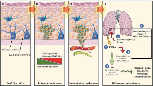 Figure 3. Melanoma development, progression and Ferroptosis susceptibility. Melanocytes are cells located in the stratum basale (a) of the skin’s epidermis, the uvea, the inner ear, meninges, vaginal epithelium, heart, and bones. They are neural crest-derived cells producing melanin, a dark pigment responsible for skin color and protection from UV light. Upon transformation, melanocytes start to grow, giving rise to the primary tumor (b). At this stage, melanoma cells display a heterogeneous grade of differentiation which correlates to Ferroptosis susceptibility. In the advanced stages, the loose of intercellular junctions and the rupture of the basal lamina allow cancer cells to invade the underlying dermis, which reaching the blood and lymphatic circuits (c) will allow them to give rise to metastases (d). Ex vivo data indicate that basal expression of AKRs seems to be not predictive of Ferroptosis sensitivity while AKRs upregulation/activation (2) in pro-ferroptotic (1) treated metastatic cells does. Indeed, if no AKRs activation/upregulation is observed, metastatic melanoma cells are efficiently killed by Ferroptosis execution (3). On the other hand, AKRs upregulation/activation will result in ferroptosis inhibition and failure of treatment. However, combined pro-ferroptotic drugs with AKRs inhibitor will efficiently increase cancer cell death through effective Ferroptosis execution (5).