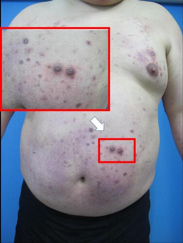 Figure 1 Clinical images of ARPC. Scattered keratotic papules on the trunk, part of the lesions may have umbilical recesses, and the shape is crater-shaped (White arrow).