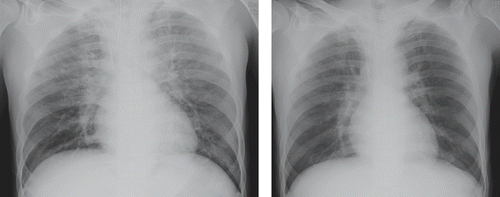 Fig. 2.  Chest x-ray of Case 3.