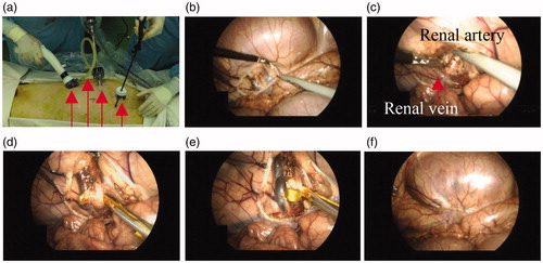 Figure 7. Images captured via laparoscopic camera during surgery. (a) Four trocars were used, of which red arrows indicate electrosurgical instrument, CO2 injection tube, laparoscopic camera, and grasper, from left, respectively. (b) Incision of a retroperitoneum. (c) A renal artery, of which surrounding nerves would be ablated, and a renal vein were dissected. (d) The electrosurgical device was inserted between a renal artery and a renal vein and (e) RF energy was applied along the parallel electrodes, which induced Nitinol shape transformation. After RDN, (f) the retroperitoneum was sutured to alleviate complications.