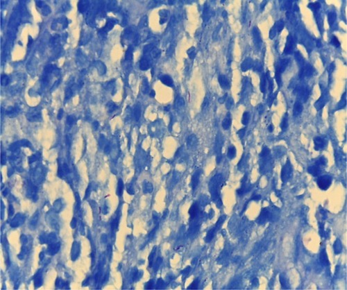 Figure 3 Acid-fast positive bacilli in the granuloma (Ziehl-Neelsen’s stain, 100×).