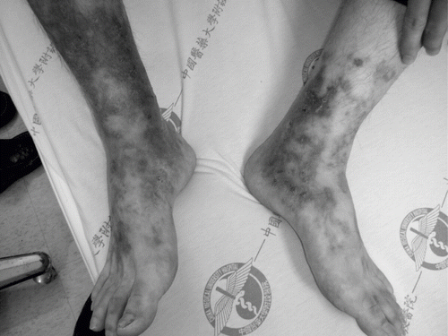 Figure 1. Skin biopsy showed characteristic pattern of small vessel leukocytoclastic vasculitis.
