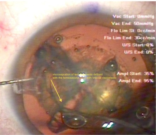 Figure 3 Visco-separation (yellow arrow) of the femto-dissected cataract quadrants. The end of the Viscoat® (Alcon, Fort Worth, TX, USA) irrigation cannula has been inserted in these two cataract quadrants, completing their physical separation. Note the retro-cataract air bubble, which can be seen escaping anteriorly, facilitated by the space created between the visco-separated cataract fragments.