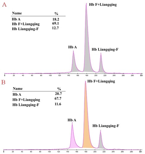 Figure 1. Hb analysis of the proband (A) and her sister (B) cord blood with Hb Liangqing in F1 by CE. They all presented a suspicious variant peak migrating behind the Hb F peak.