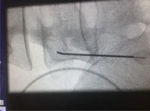 Figure 1 L4 medial branch neurotomy.