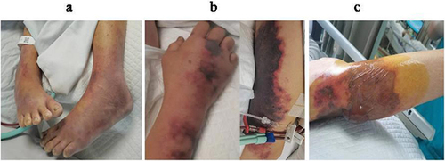 Figure 3 Characteristic features of Streptococcal Infected Limbs.