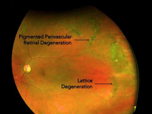 Figure 6 Fundus image of pigmented perivascular retinal degeneration extending radially and posteriorly, as seen in some Stickler syndrome pedigrees.