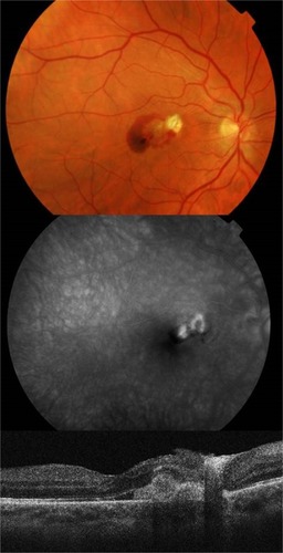 Figure 1 Juxtafoveolar subretinal choroidal neovascularization with subretinal fluid adjacent to the choroidal rupture 2 months after vitrectomy demonstrated by optical coherence tomography and fluorescein angiography.