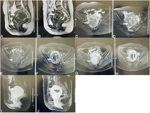 Figure 3. MR images of the lesion on T2WI: (A) and (C) are pretreatment images; (B) and (D) are post-HIFU images. Contrast-enhanced MR images of the lesion on T1WI: (E) pretreatment image in the arterial phase, (G) and (I) pretreatment images in the venous phase; (F) post-HIFU image in the arterial phase, (H) and (J) post-HIFU images in the venous phase.