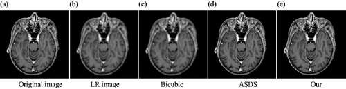 Figure 3. Comparison of the reconstructed images of various methods for noiseless medical image (Equation1(1) x≈Φα(1) ) (a) Original image (b) LR image (c) Bicubic (d) ASDS (e) Our.