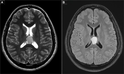 Figure 2 Axial T2-weighted (A) and fluid-attenuated inversion recovery (FLAIR) (B) images of the brain showing a well-defined, rounded lesion at the posterior part of the third ventricle.