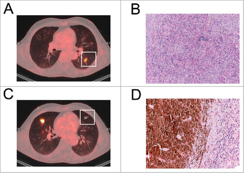 Figure 1. Development of pneumonitis during PD-1 blockade. (A, B) An FDG-positive pulmonary lesion of patient 1 (A) was resected and presented as organizing pnmeumonia in the histological examination (B). (C, D) An FDG-negative lesion in the same patient was resected (C) and a necrotic melanoma metastasis was found by histological analysis (D).