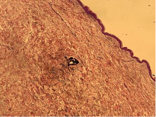 Figure 2 Large, pigmented cluster on the haematoxylin and eosin-stained histological sample.